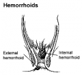 Hemorrhoids.png