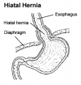 Hiatal-Hernia.png