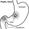 Peptic-Ulcer.png
